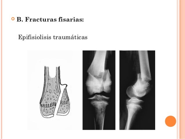 epifisiolisis traumatica